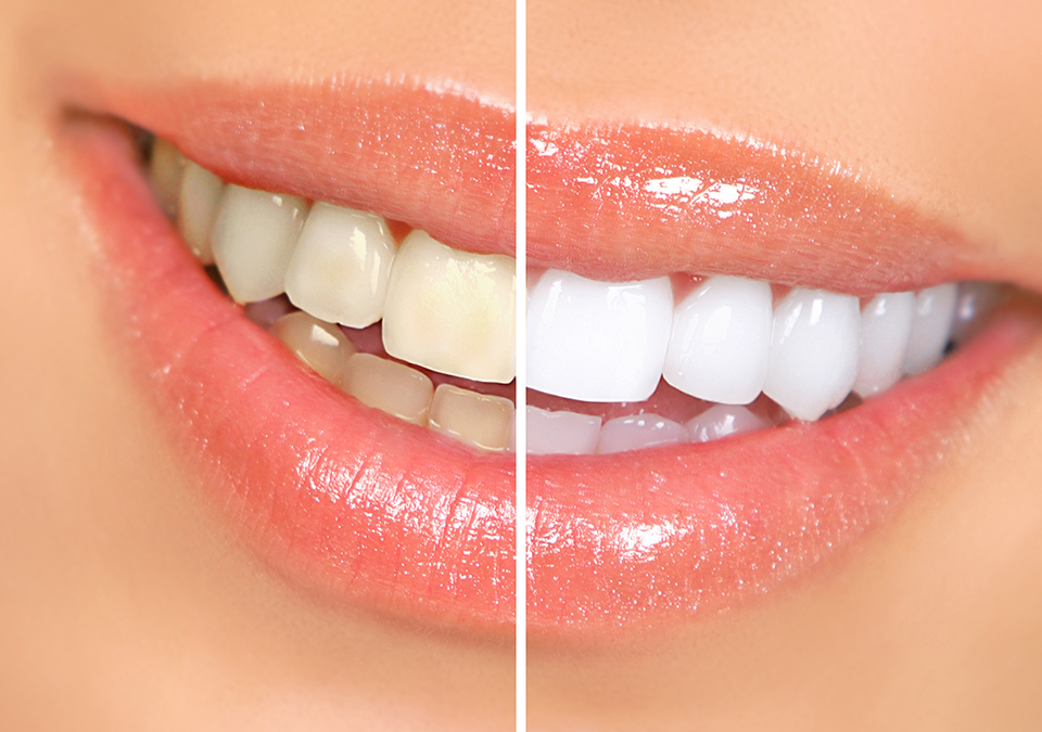 Teeth Whitening Patient At Kilgore Tx Cosmetic Dentist