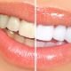 Teeth Whitening Patient At Kilgore Tx Cosmetic Dentist
