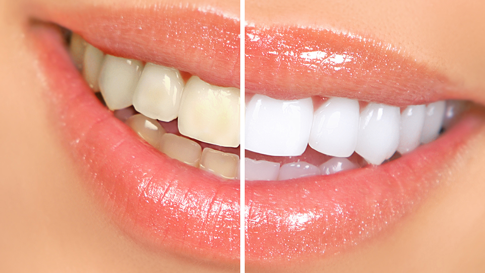 Teeth Whitening Patient At Kilgore Tx Cosmetic Dentist